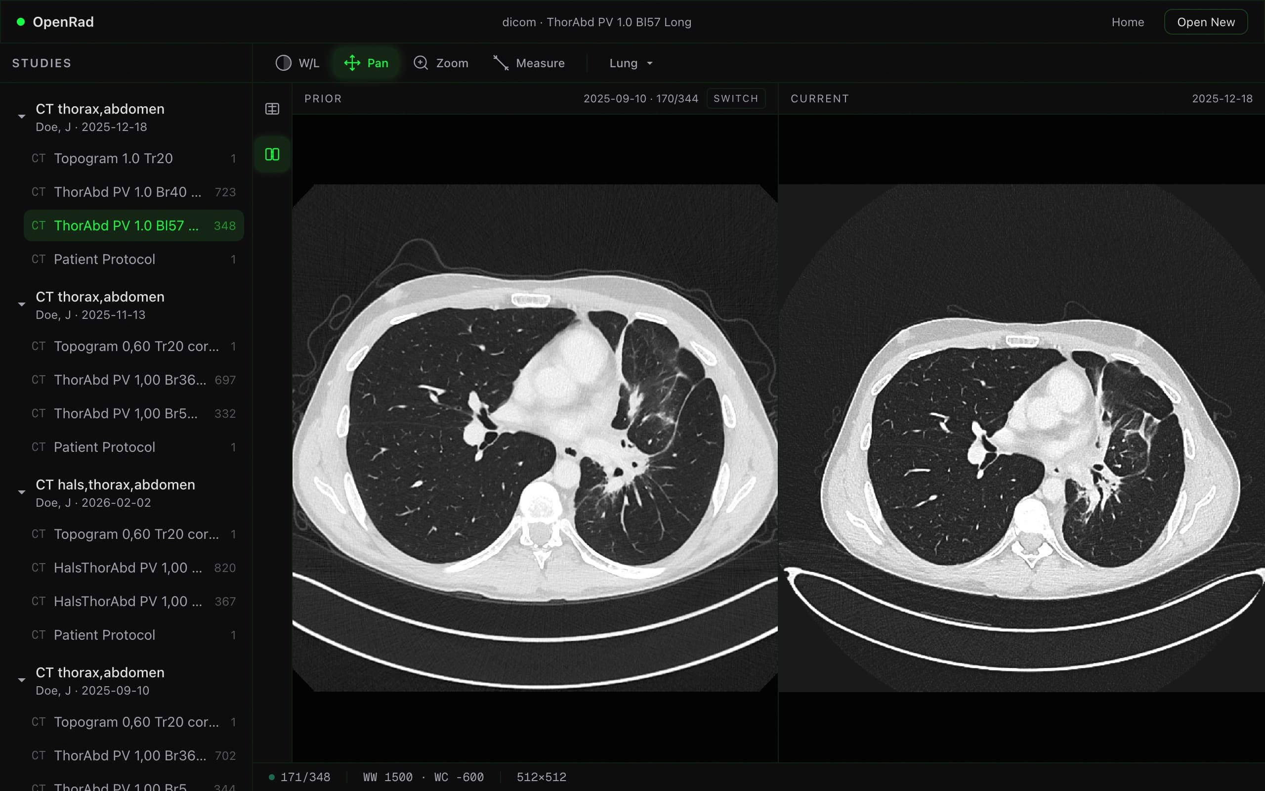 openrad viewer showing a CT scan
